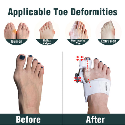 Adjustable Bunion Corrector & Toe Straightener – Relieve Pain & Realign Big Toe Naturally